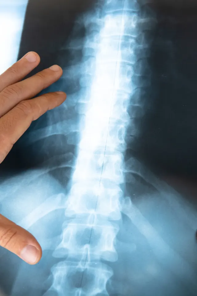 A hand holding a lumbar spine X-ray film up to the light